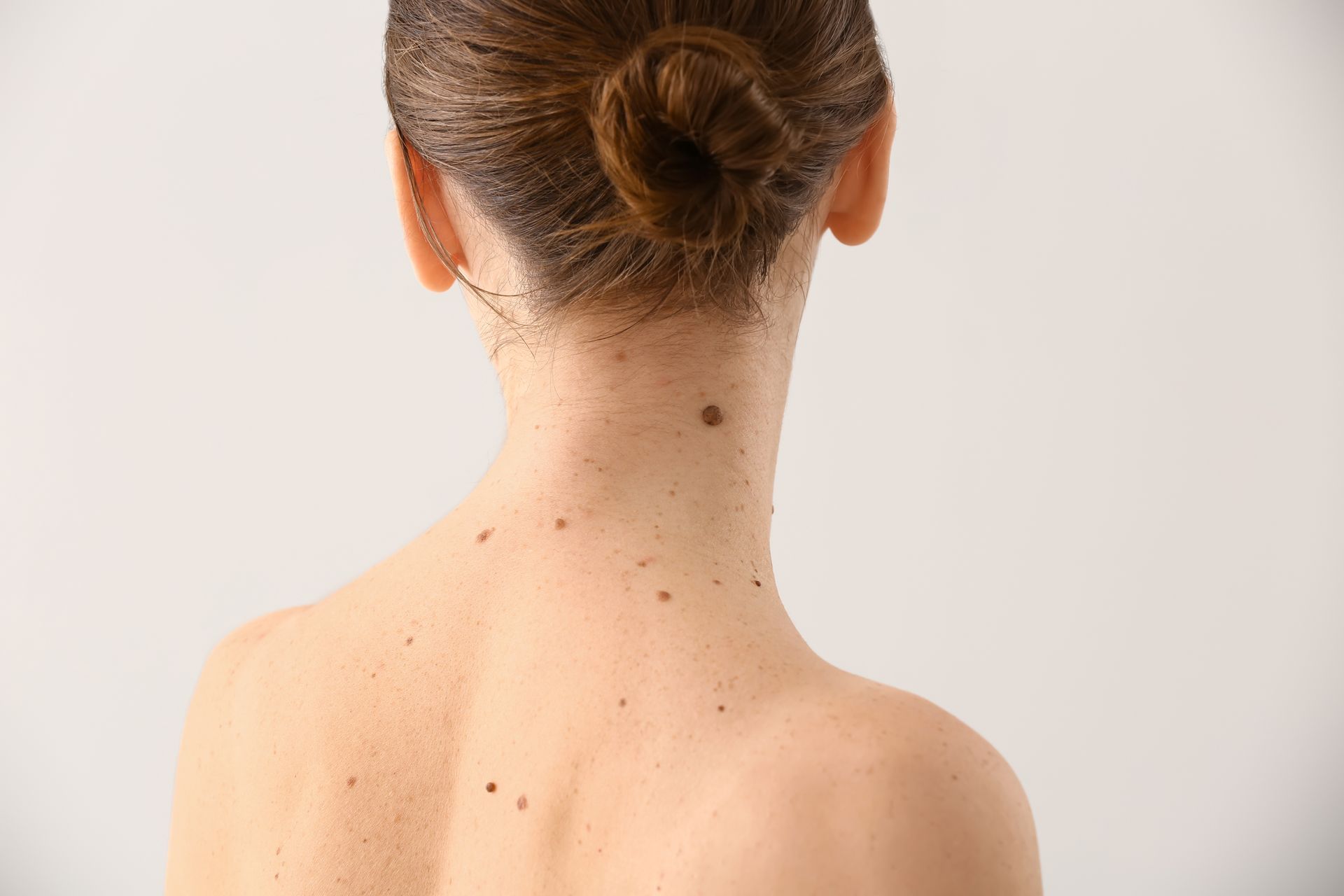 The back of a person’s neck and shoulders, showing several small, dark moles against their light skin.