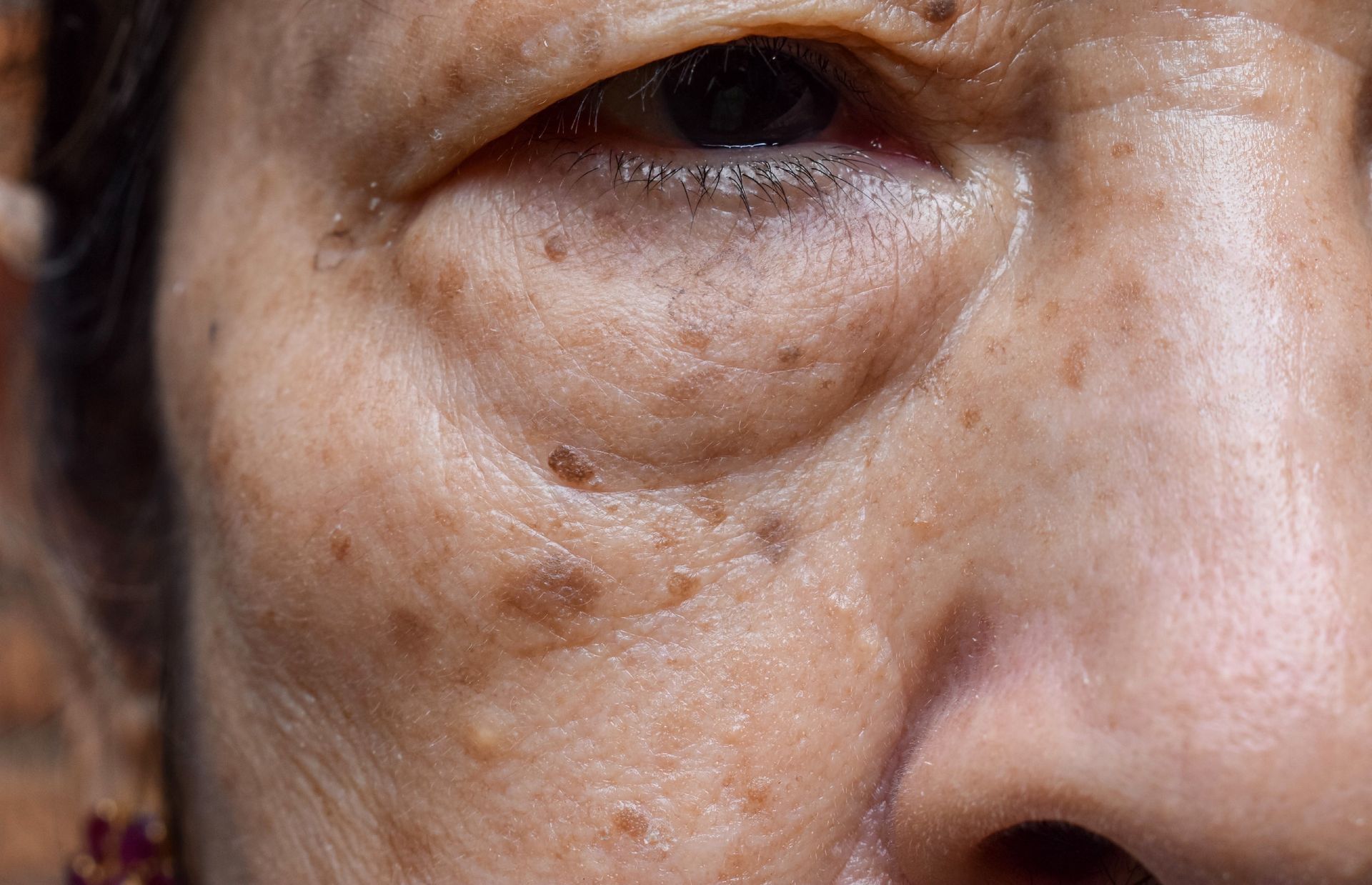 Close-up of human skin around the eye area showing multiple small, flat, light-brown spots and pigmented lesions.