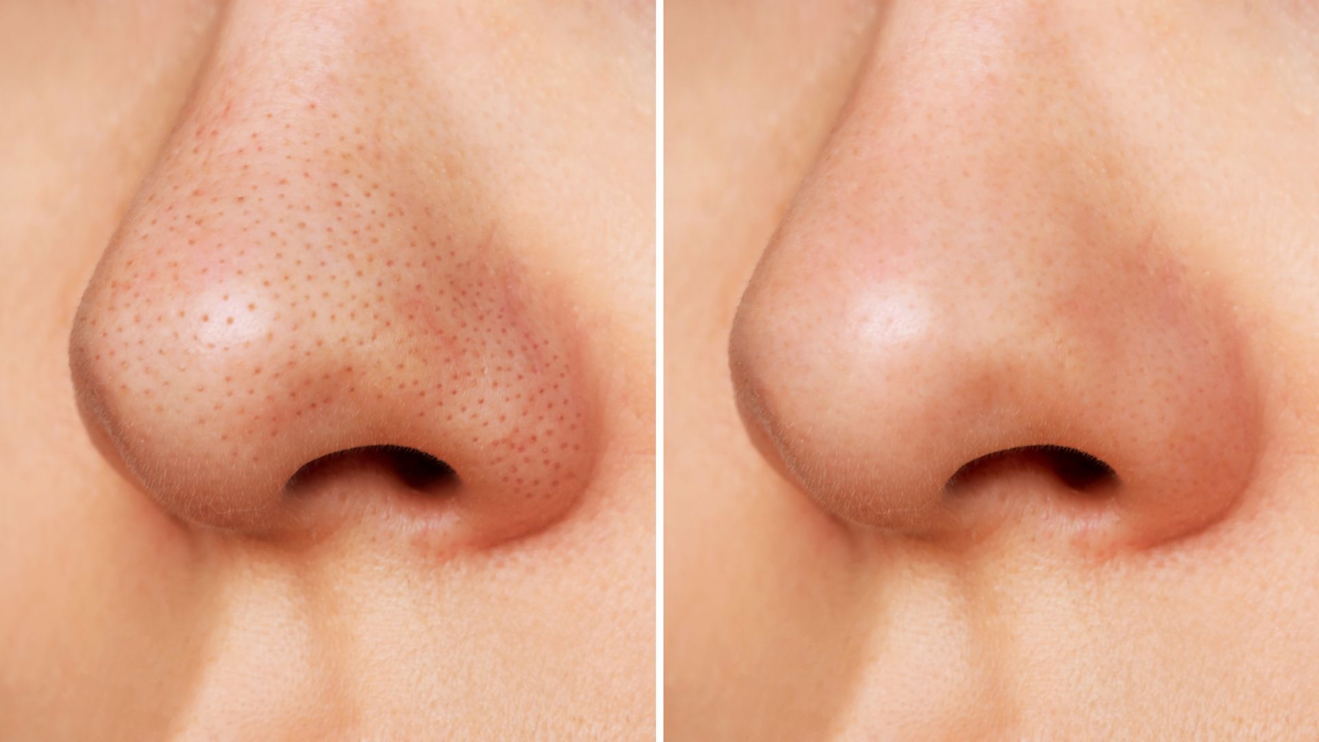 Comparison of a nose with visible pores (left) and smoother skin (right).