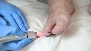 Fungal Nail Treatment