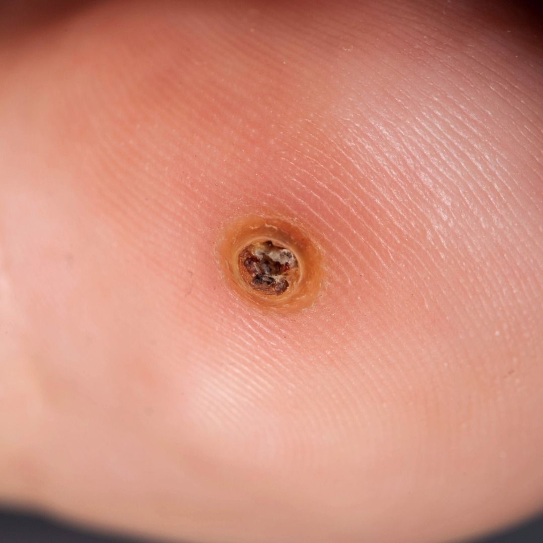 Verruca treatment at Plymouth Podiatry