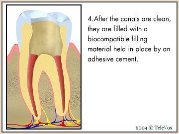 Biocompatible Filling In Root Canal — Plymouth, MI — Leslie M Woodell DDS