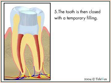Closing Tooth Using Temporary Filling — Plymouth, MI — Leslie M Woodell DDS