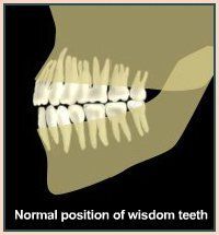 Position Of Wisdom Tooth — Plymouth, MI — Leslie M Woodell DDS