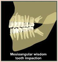 Mesioangular Wisdom Tooth Impaction — Plymouth, MI — Leslie M Woodell DDS