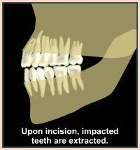 Impacted Teeth Should Extract — Plymouth, MI — Leslie M Woodell DDS