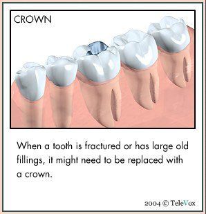 For Replacement Of Crown — Plymouth, MI — Leslie M Woodell DDS