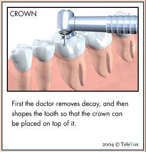 Dentist Removes Decay — Plymouth, MI — Leslie M Woodell DDS
