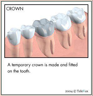 Temporary Crown — Plymouth, MI — Leslie M Woodell DDS