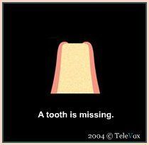 Tooth Is Missing — Plymouth, MI — Leslie M Woodell DDS