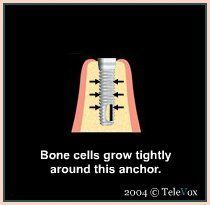 Bone Cells Around Anchor — Plymouth, MI — Leslie M Woodell DDS