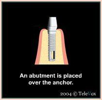 Abutment Is Placed Over The Anchor — Plymouth, MI — Leslie M Woodell DDS