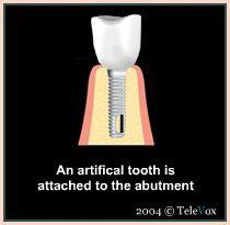 Artificial Tooth Attached To The Abutment — Plymouth, MI — Leslie M Woodell DDS