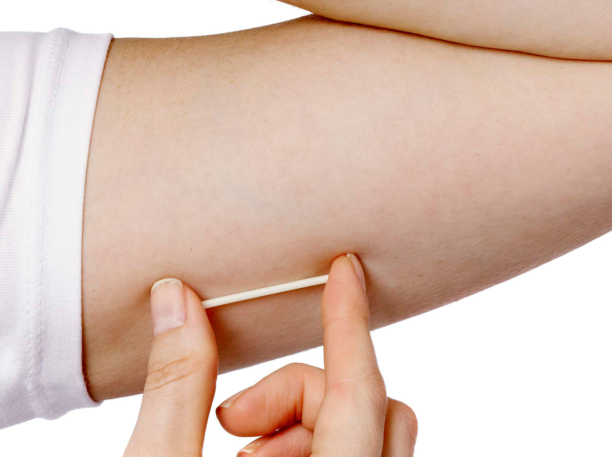 implante subdérmico ventajas y desventajas