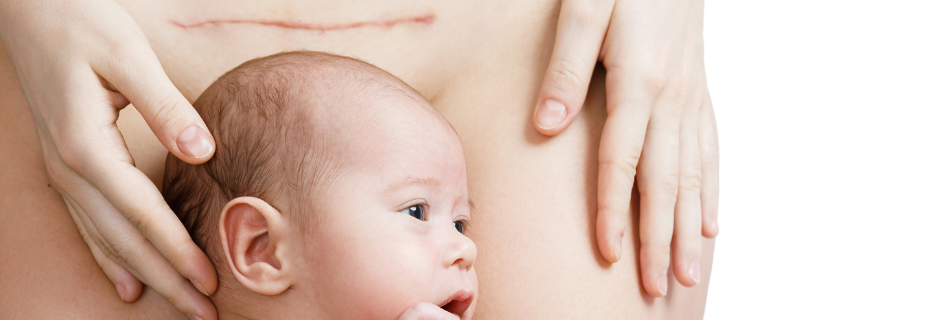 cesarea o parto natural