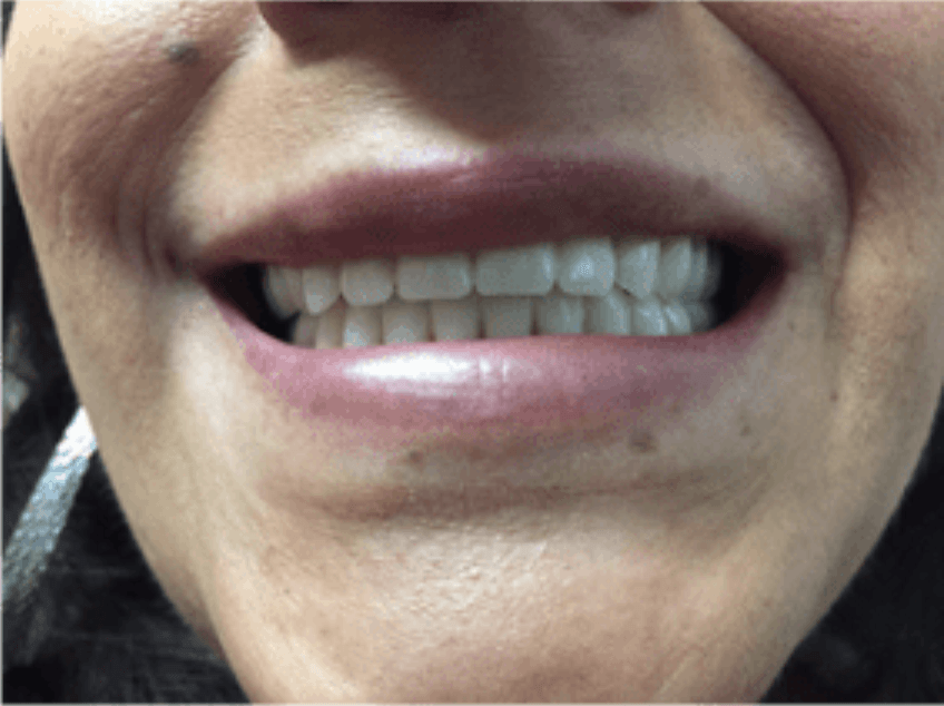 After Denture Replacement