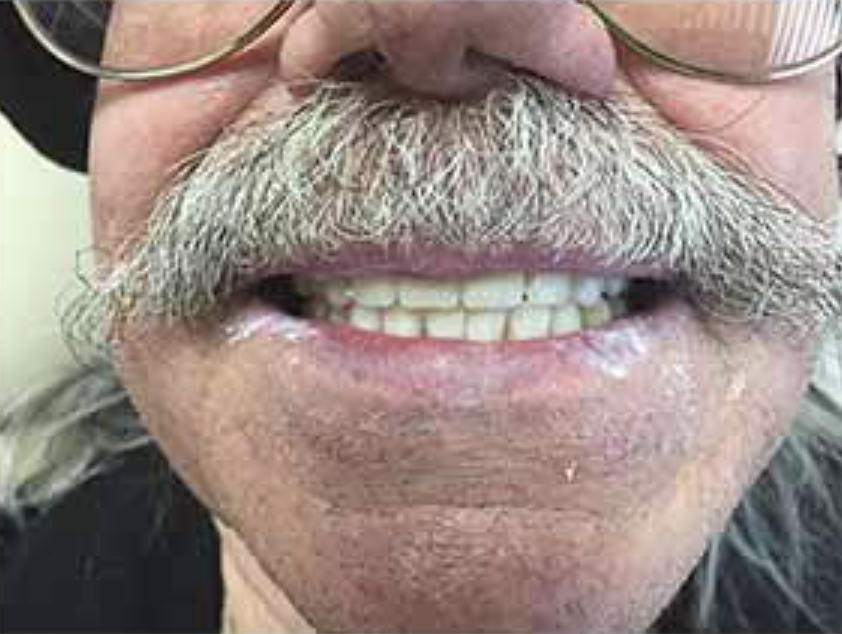 After Denture Replacement