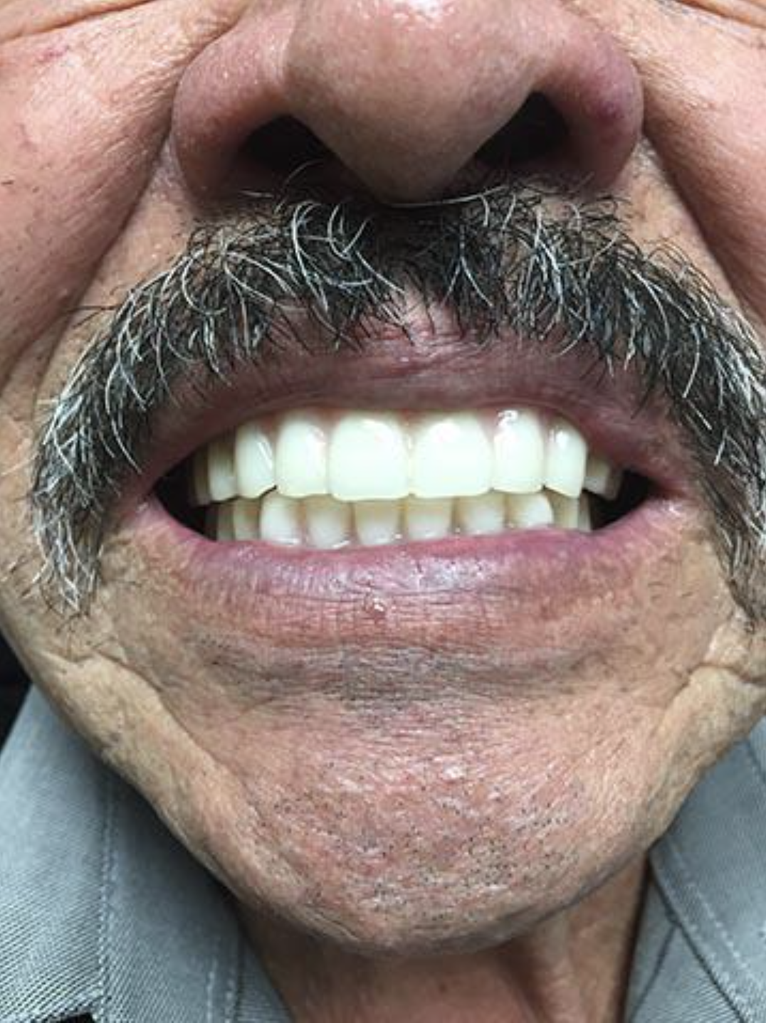 Denture Results