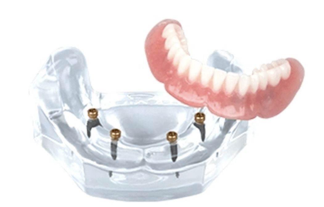 Implants
