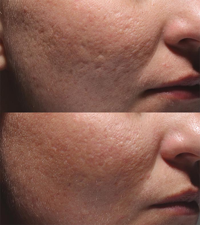 Before And After Injectables — Frankfort, IL — Midwest Anti-Aging and Med Spa