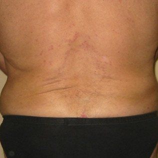 After HCG Treatment — Frankfort, IL — Midwest Anti-Aging and Med Spa