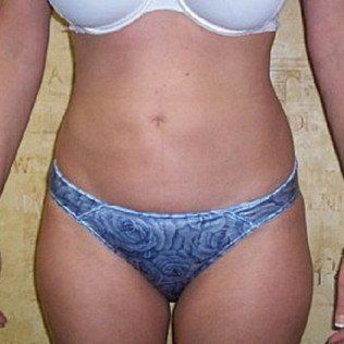 Liposuction After Front View — Frankfort, IL — Midwest Anti-Aging and Med Spa