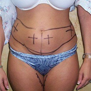 Liposuction Before Front View — Frankfort, IL — Midwest Anti-Aging and Med Spa