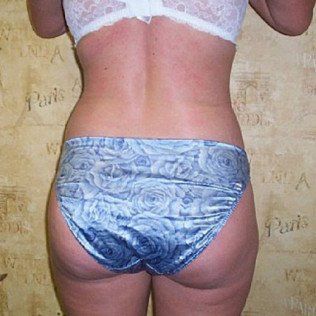Liposuction After Back View — Frankfort, IL — Midwest Anti-Aging and Med Spa