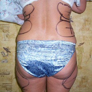 Liposuction Before Back View — Frankfort, IL — Midwest Anti-Aging and Med Spa