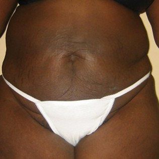 Cellulite Reduction After Front View — Frankfort, IL — Midwest Anti-Aging and Med Spa