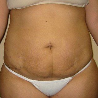 Body Sculpting After Front View — Frankfort, IL — Midwest Anti-Aging and Med Spa