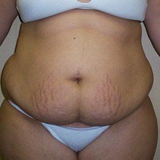 Body Sculpting Before Front View — Frankfort, IL — Midwest Anti-Aging and Med Spa