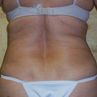 After Full Body Sculpting — Frankfort, IL — Midwest Anti-Aging and Med Spa