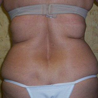 Before Full Body Sculpting — Frankfort, IL — Midwest Anti-Aging and Med Spa