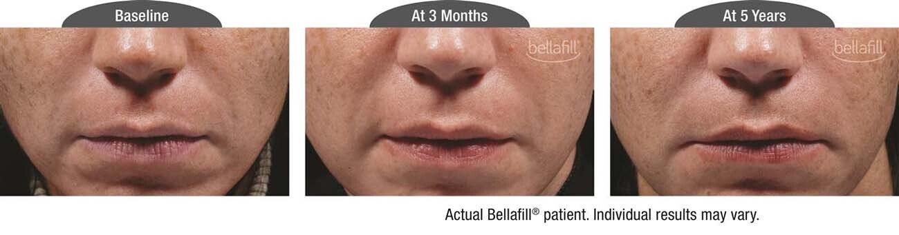 Actual Bellafill Treatment In 5 Years — Frankfort, IL — Midwest Anti-Aging and Med Spa