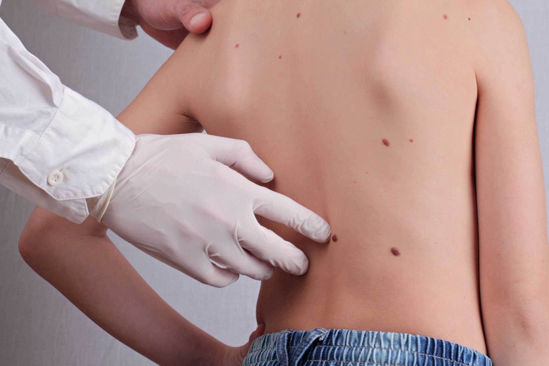 dermatologist examines moles on child's back