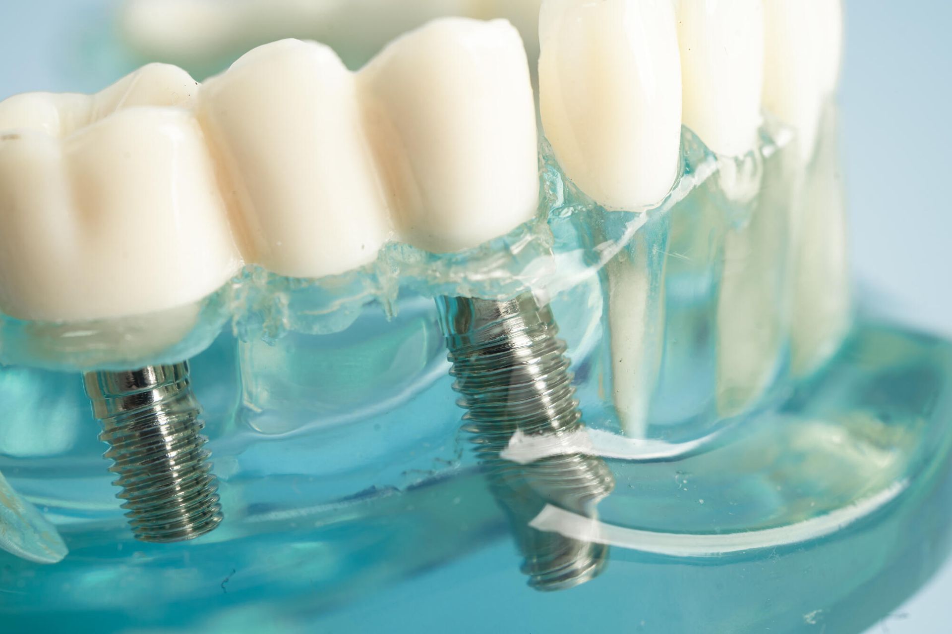 A close up of a model of teeth with dental implants.