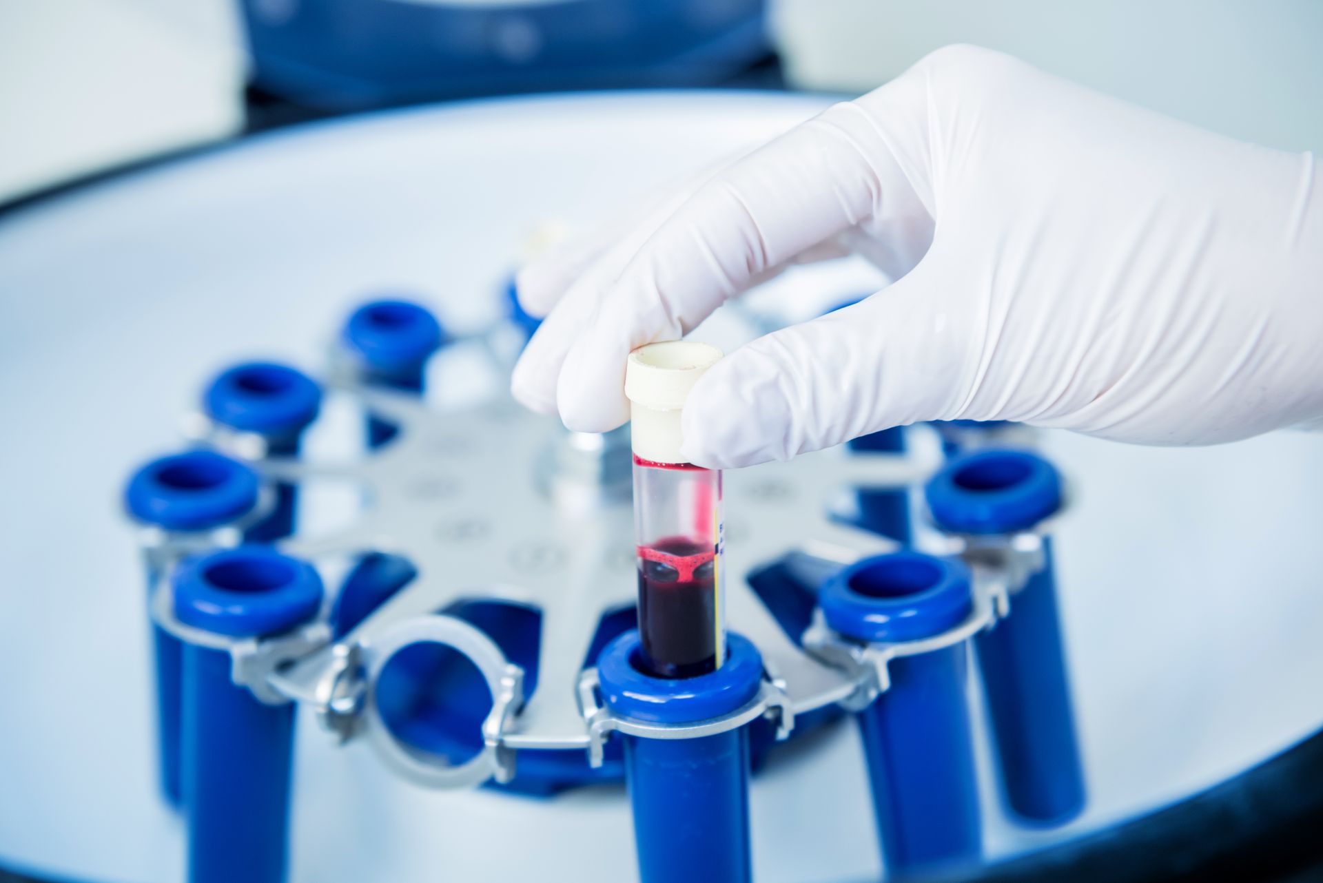 Platelet-Rich Plasma preparation. Tube with blood in hands