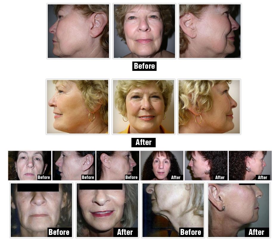 Before and after face lifts — Hendersonville, TN — Kush Frenchman, M.D.