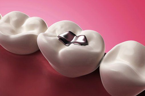 Teeth Filling — Dental Health in Oakhurst, CA
