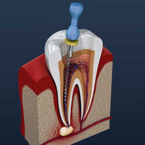 root canal