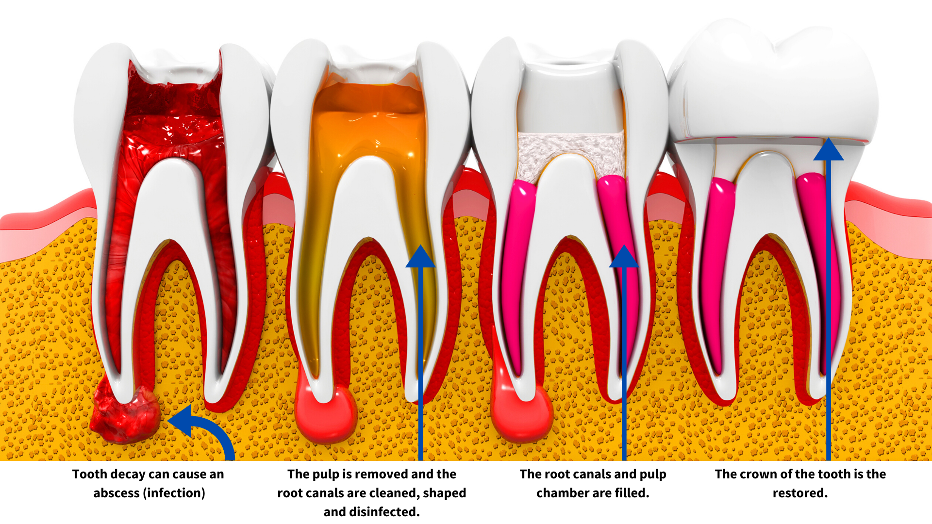 root canal diagram