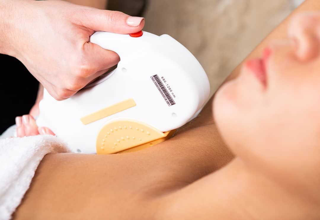 Epilation lumière pulsée