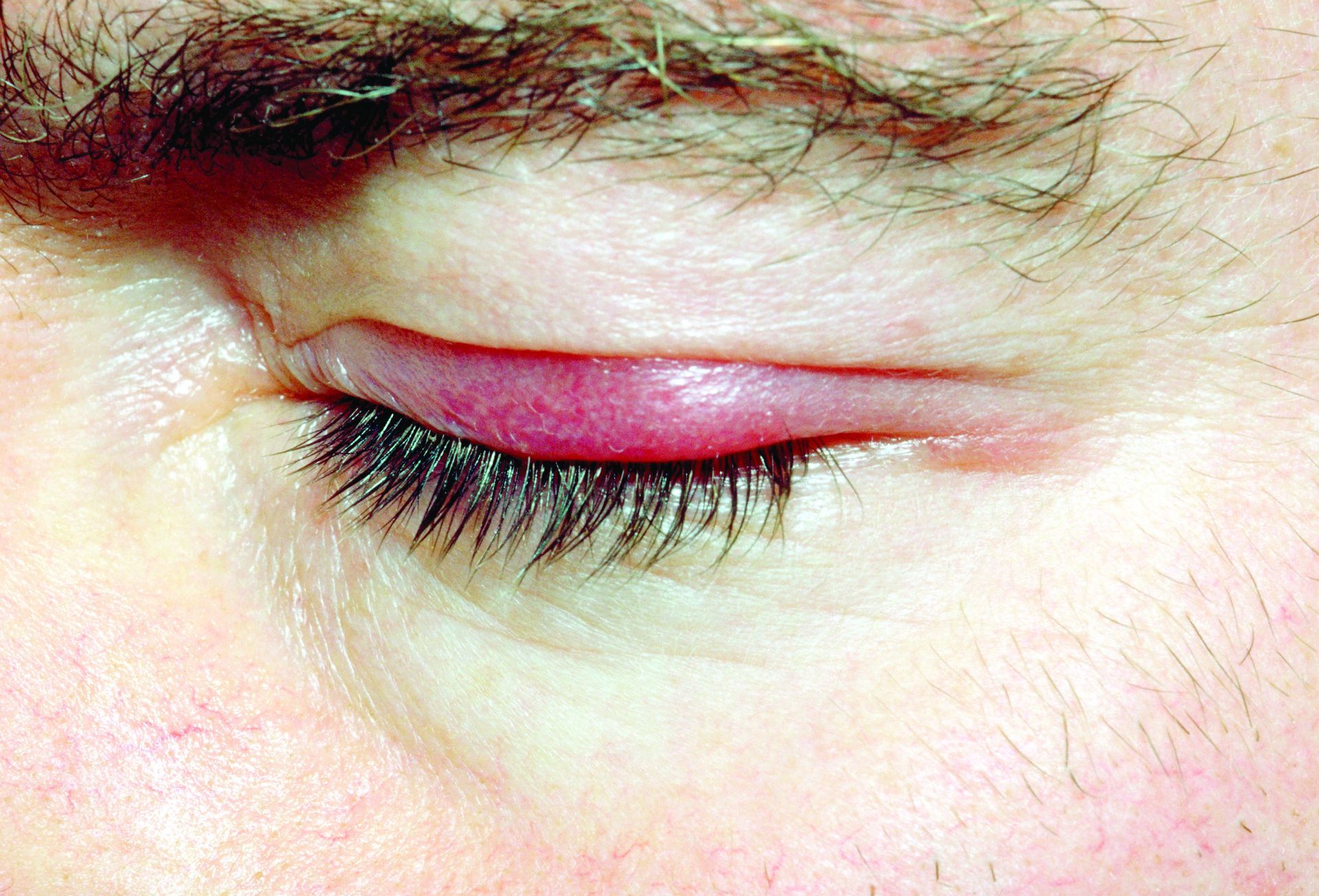 Swollen, red upper eyelid with visible eyelashes and brow.