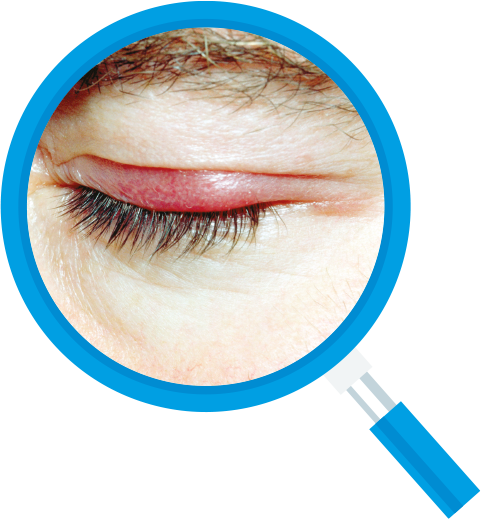 Eye with a red, swollen stye on the eyelid, magnified with a blue magnifying glass.