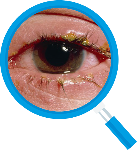 Close-up of an eye with red, swollen eyelids, and yellow crust around the lashes, viewed through a magnifying glass.