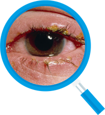 Close-up of an eye with red, swollen eyelids, and yellow crust around the lashes, viewed through a magnifying glass.
