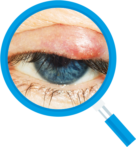 Eye with a red, swollen eyelid, viewed under a magnifying glass.