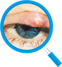 Eye with a red, swollen eyelid, viewed under a magnifying glass.