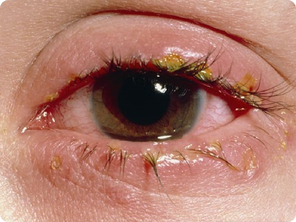 Eye with inflamed eyelids, crusting, and redness.
